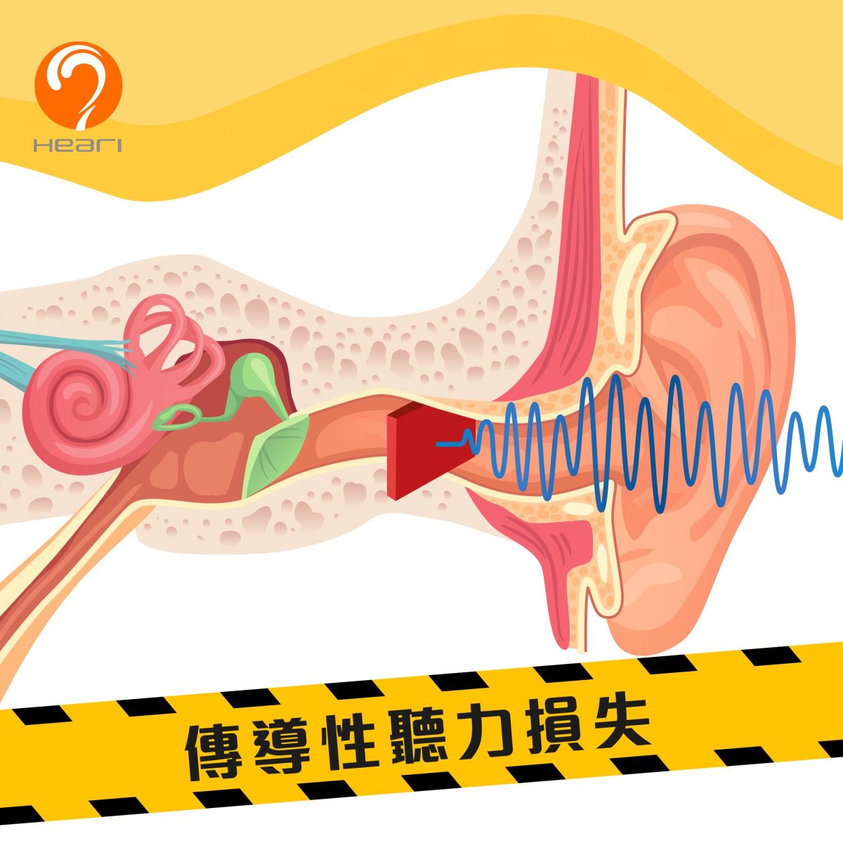傳導性聽力損失 | Heari助聽器