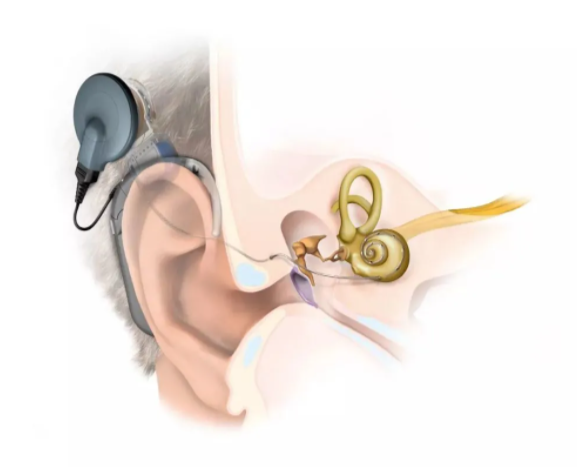 人工耳蝸 | Heari 助聽器